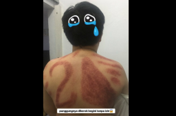 Viral Foto Punggung Jadi Alat Kampanye Tukang Kerok