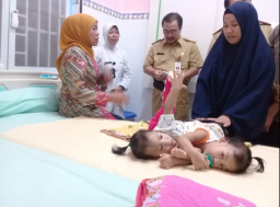 Jadwal Operasi Kembar Siam Asal Kendari Diputuskan Lebih Cepat