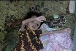 Bayi Gizi Buruk di Lamongan, Akhirnya Meninggal