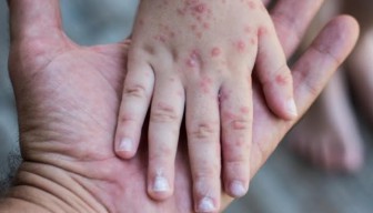 Kasus Campak di Sumenep Tembus 800, Empat Anak Meninggal Dunia