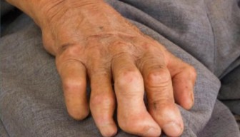 Kasus Kusta di Sumenep Turun Drastis Menjadi 150 Pasien, Dinkes Ingatkan Pentingnya Disiplin Berobat