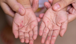 Tiga Bulan Berstatus KLB, Sumenep Tunggu Restu Kemenkes Cabut Wabah Campak