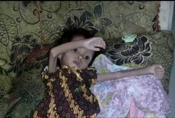 Bayi Gizi Buruk di Lamongan, Akhirnya Meninggal