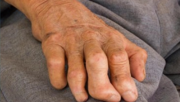 Kasus Kusta di Sumenep Turun Drastis Menjadi 150 Pasien, Dinkes Ingatkan Pentingnya Disiplin Berobat