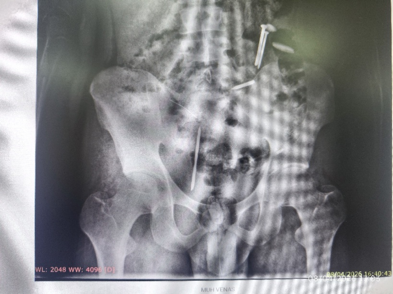 Hasil foto CT Scan terdapat logam mirip paku di tubuhnya