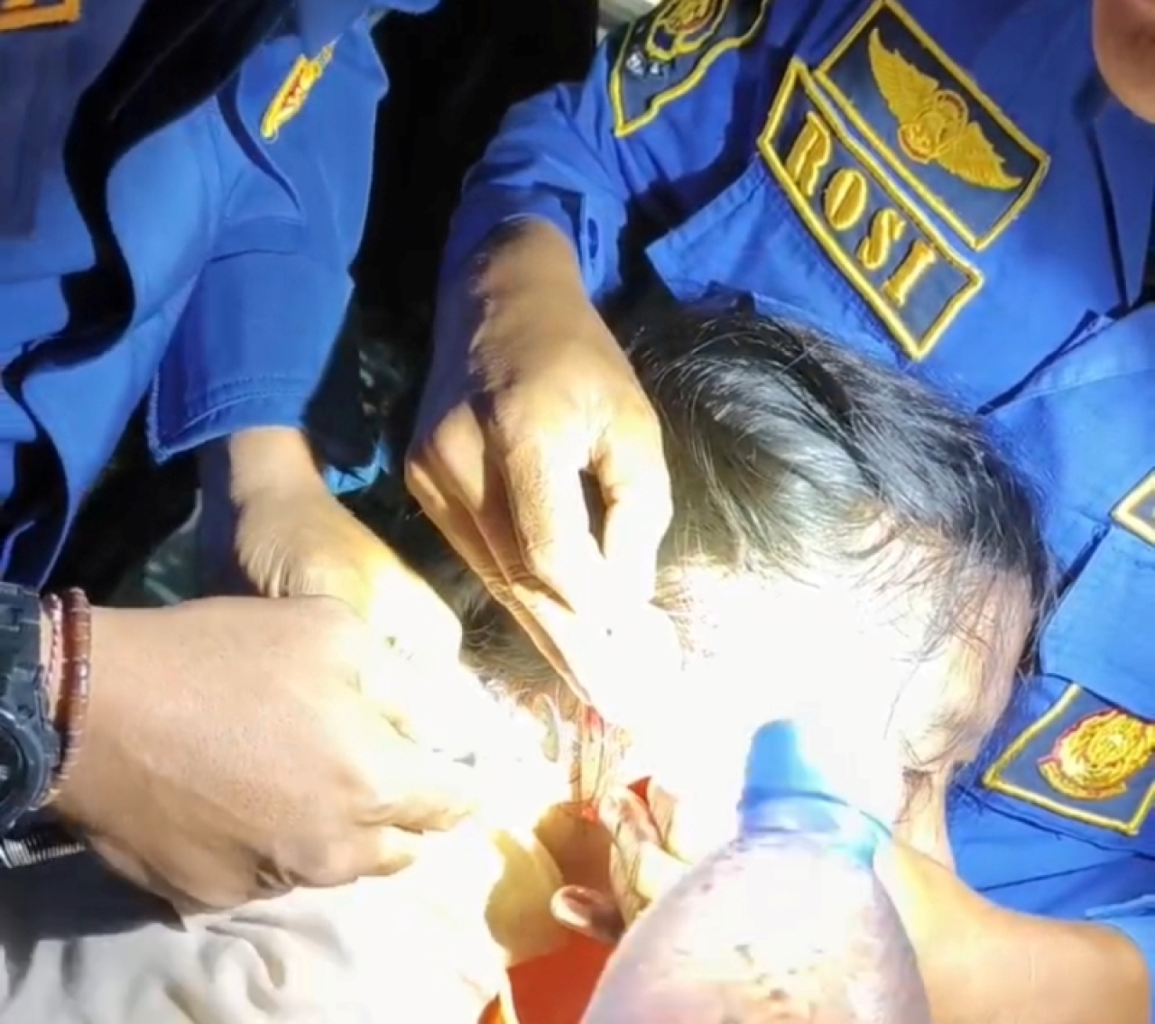 Anting Tersangkut Sampai Telinga Bengkak, Remaja di Jember Menangis Minta Bantuan Damkar